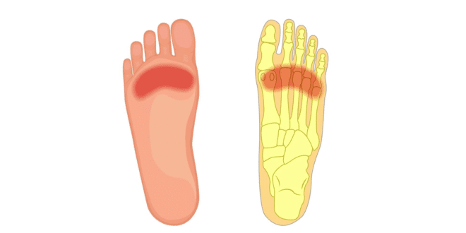 Superfoot Body-6 Foot Condition  