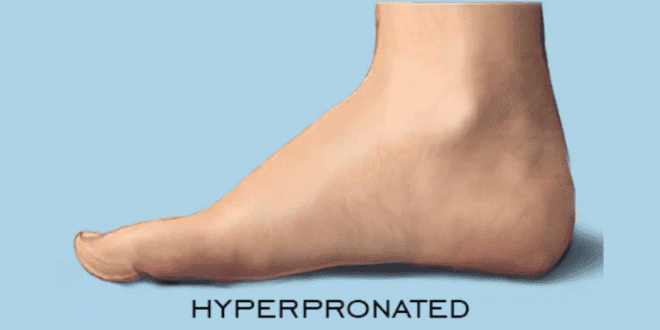 Superfoot Hyperpronated Foot Characteristics  