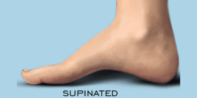 Superfoot Supinated Foot Characteristics  